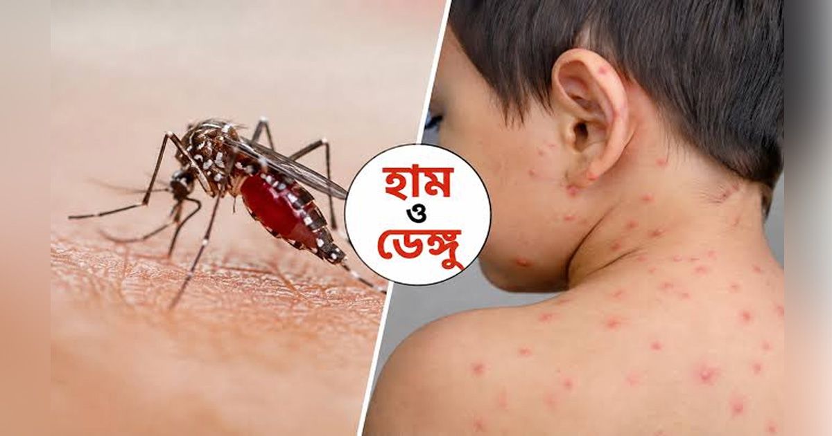 ডেঙ্গু ও হামের রোগীদের চিকিৎসায় হাসপাতালগুলোতে বাড়ছে চাপ